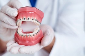 Closeup of orthodontist placing metal brackets on patient's teeth