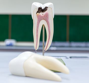 Model of the inside of a damaged tooth in need of root canal therapy