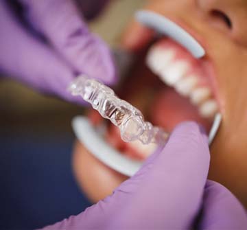 Orthodontist in Clinton putting Invisalign tray on patient