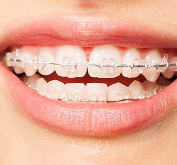 Closeup of smile with clear and ceramic braces