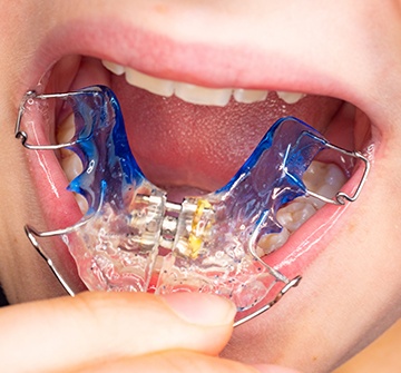 Closeup of patient placing retainer oral appliance