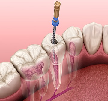 Animated smile during root canal therapy