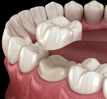 Animated smile during dental crown placement