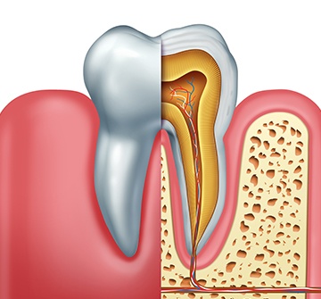 Animated inside of tooth in need of root canal therapy