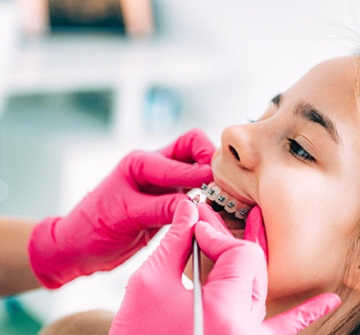 Orthodontist in Clinton placing braces on patient