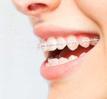 Closeup of patient smiling with braces in Clinton